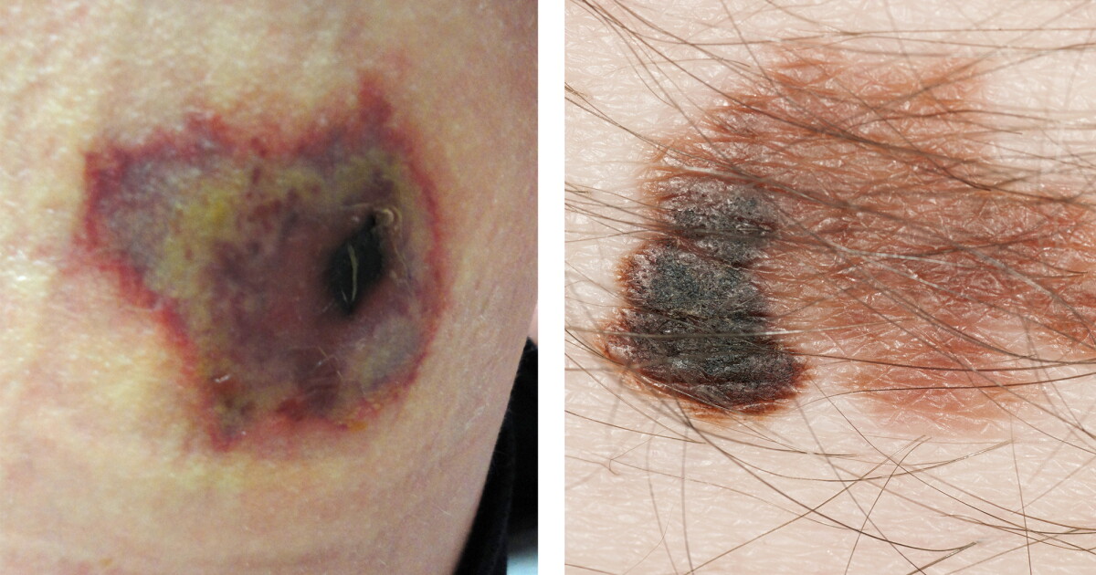 tobacco on spider bite Industry Deceit What to do when a