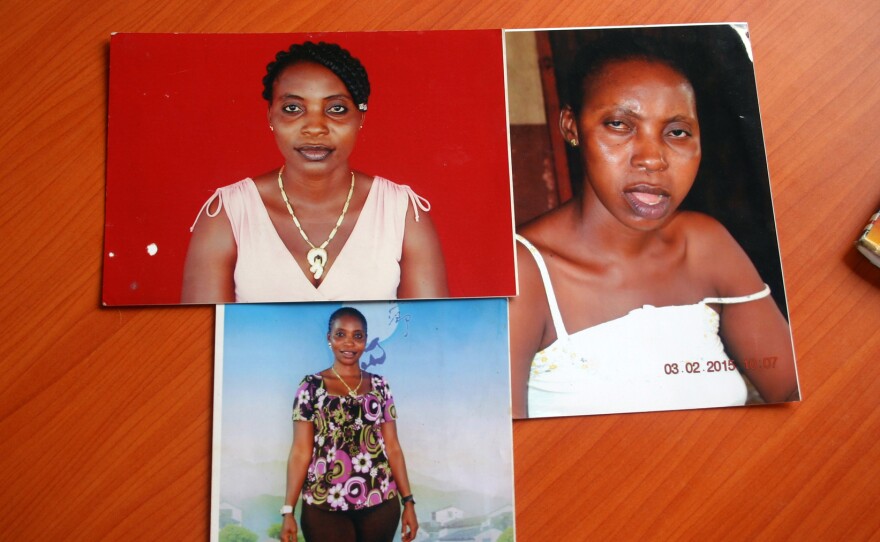 Jaimama Konneh is an Ebola survivor. The two photos on the left are before Ebola. The one on the right is from after. She's had significant swelling in her jaw and says at times she can't close her mouth or swallow. She's also suffered headaches and for a while had trouble seeing out of her right eye.