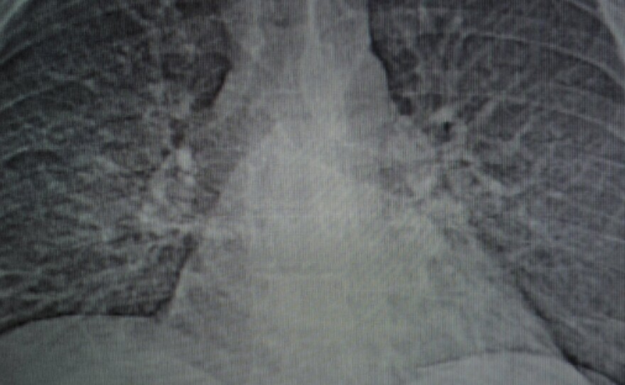 A CT scan shows the damage to Danny Smith's lungs caused by progressive massive fibrosis.