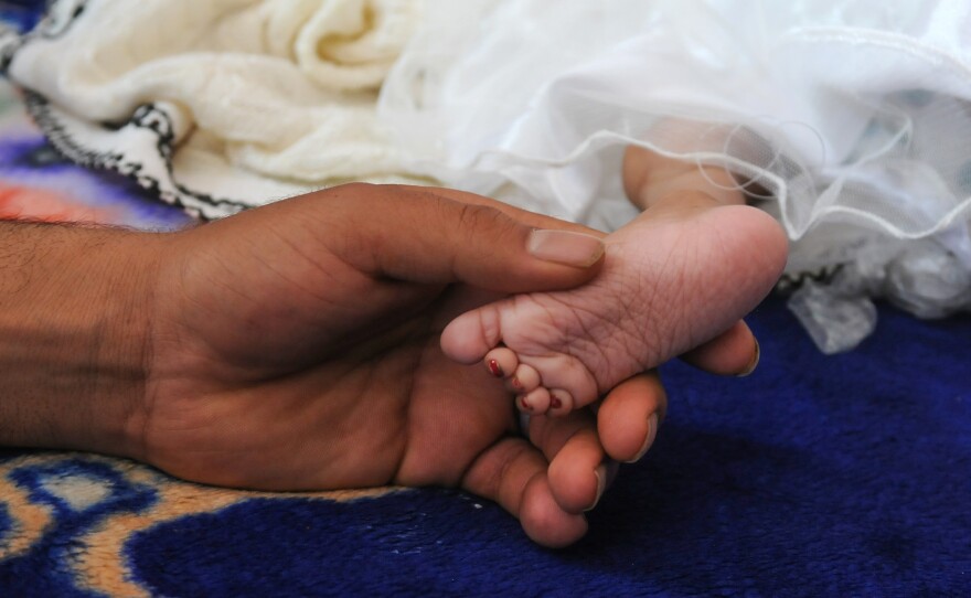 A malnourished child receives medical treatment in Sanaa, Yemen.