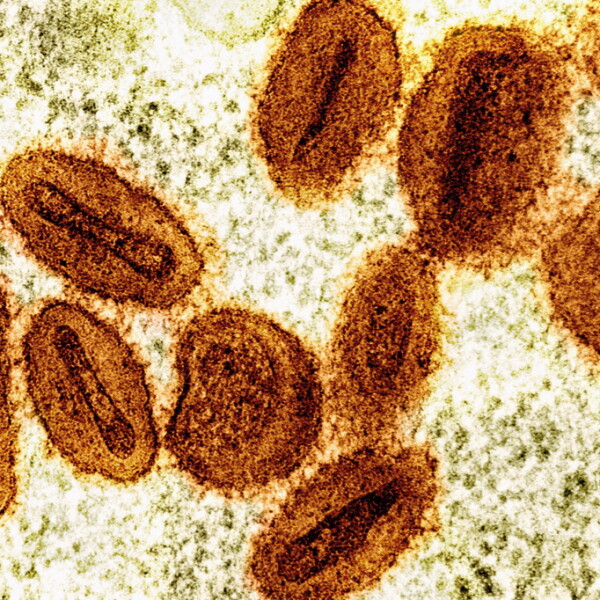 San Diego County Resident Diagnosed with More Severe Mpox Strain