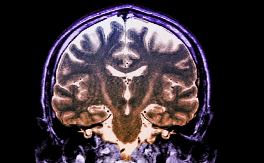 Patients with a fast-progressing form of ALS who got daily doses of an experimental two-drug combination called AMX0035 scored higher on a standard measure of disability than patients who didn't get the drug.