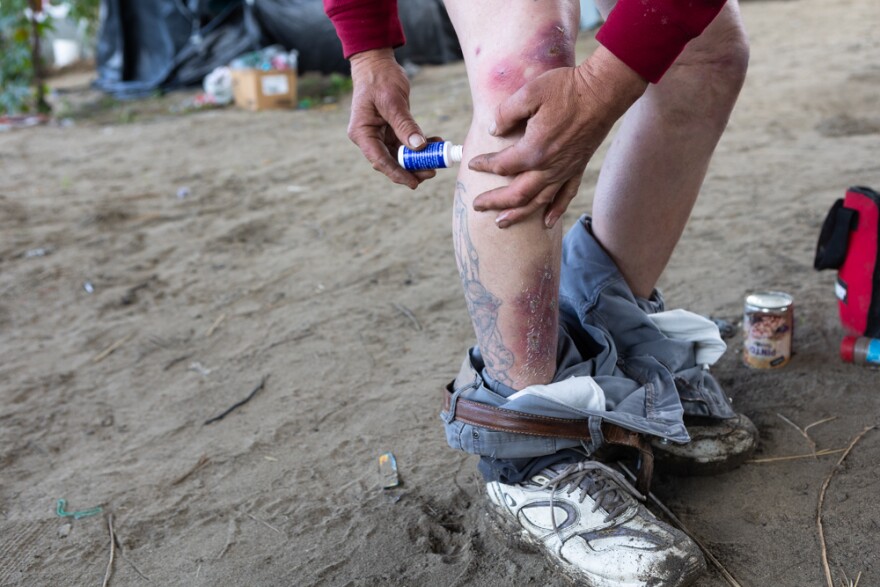 Jerrod Starbird applies bleach to infections on his leg which he says have gotten worse because of walking through the San Diego River, March 25, 2024.