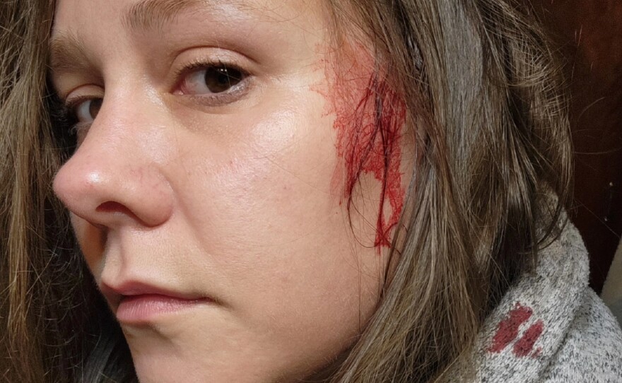 Kirsten Mathisen after one of her attacks by a barred owl.