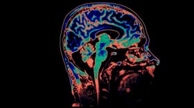 Brain Scan - CAT Scan and MRI scan in color.