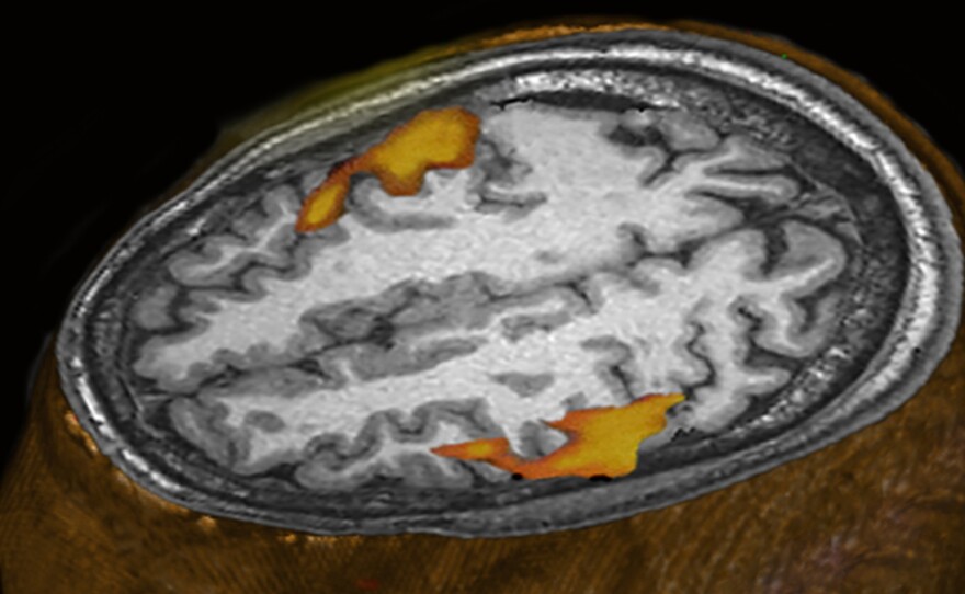 An MRI scan of a person listening to music shows brain areas that respond. (This scan wasn't part of the research comparing humans and monkeys.)
