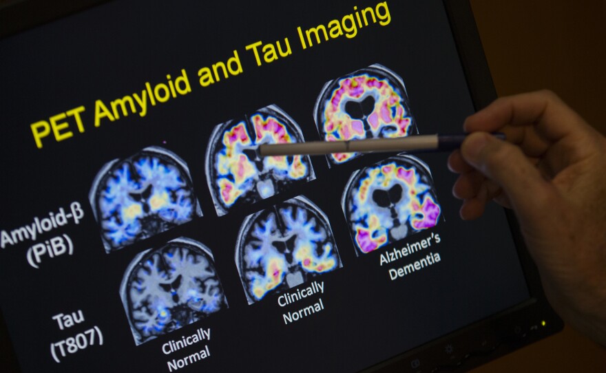 In a May 19, 2015 file photo, R. Scott Turner, Professor of Neurology and Director of the Memory Disorder Center at Georgetown University Hospital, points to PET scan results that are part of a study on Alzheimer's disease at Georgetown University Hospital, in Washington.