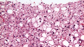 Multicolor stained micrograph of liver biopsy showing hepatocellular carcinoma. Blue staining depicts collagen fibrosis. 