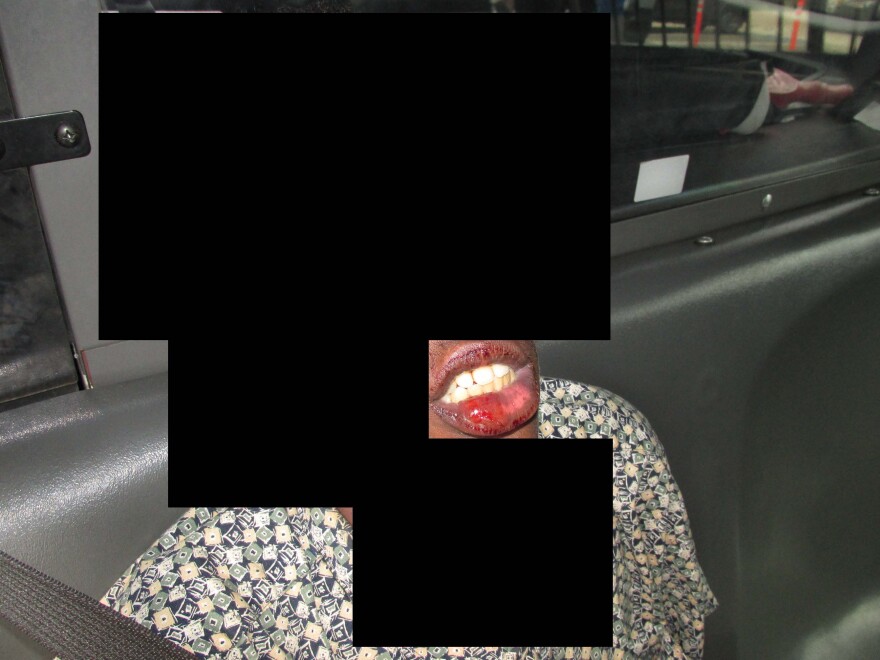 A man's bloody lip is shown in a police evidence photo after San Diego Police Officer Timothy Romberger smashed him into a police vehicle. San Diego, Calif. Aug. 6, 2017.