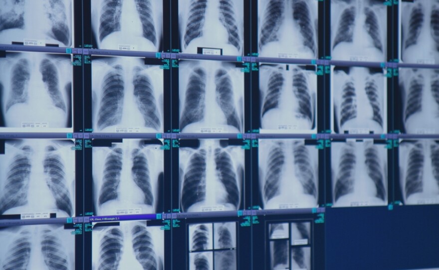 Lungs riddled with fibrotic tissue from complicated black lung disease are displayed in the office of radiologist Brandon Crum in Pikeville, Ky.