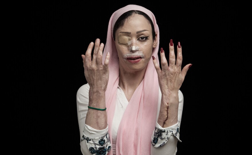 A woman in Iran shows her injuries from an acid attack. Victims of this kind of violence are often women and children. The trigger may be a family conflict, a rejected marriage proposal or a desire for revenge.