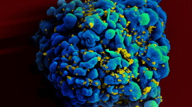 Scanning electromicrograph of an HIV-infected H9 T cell.