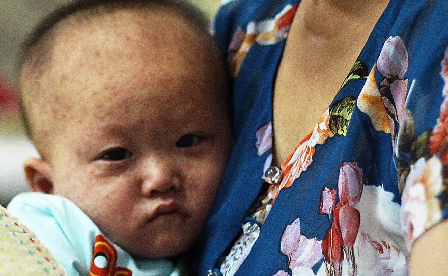 A Vietnamese boy is treated for measles in a state-run hospital in April 2014.