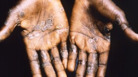 The palms of a patient with mpox during an outbreak in the Democratic Republic of Congo in 1997. The country is now seeing a dramatic spike in mpox — with a strain that is deadlier than the one that sparked the global outbreak in 2022.