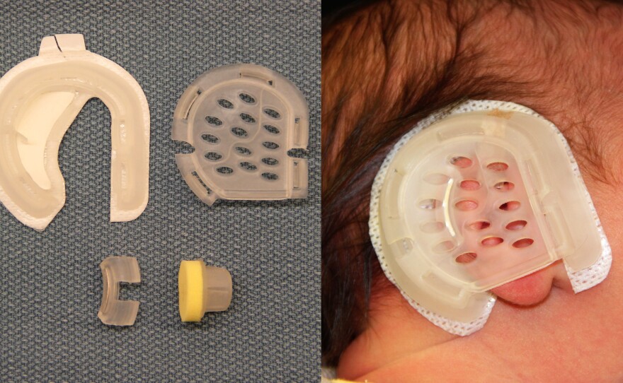 The EarWell device attaches to a baby's head with adhesive tape and is worn for two to six weeks.