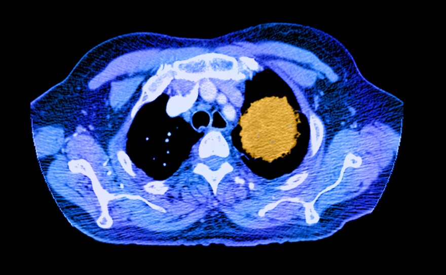 A color-enhanced spiral CT image of the chest shows a large cancerous mass (in yellow) in the left upper lobe.