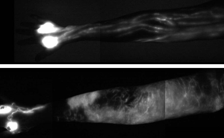 The image of a normal upper arm (top) shows the delicate network of healthy lymph vessels. In the lower image of a patient with lymphedema, a collection of lymph fluid, in white, has made the arm swell.