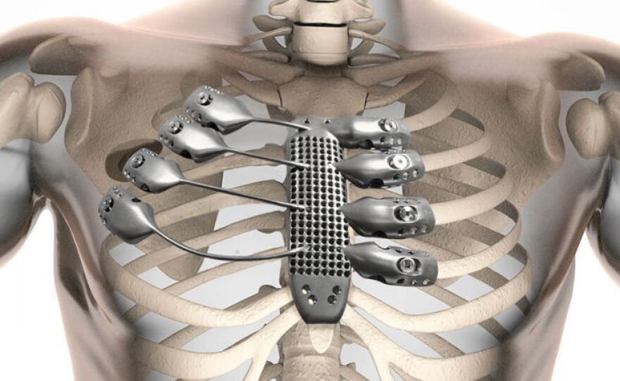 The implant was custom-designed using CT scans of a cancer patient's chest. The man lost his sternum and four ribs during surgery to remove a tumor.