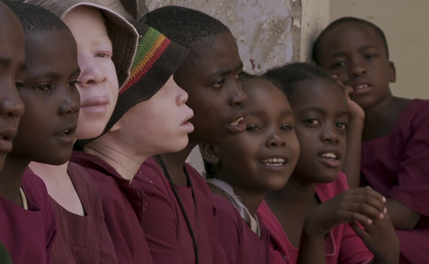 In countries around the African Great Lakes region, including Tanzania, some witch doctors believe that the body parts of people with albinism have magic power.