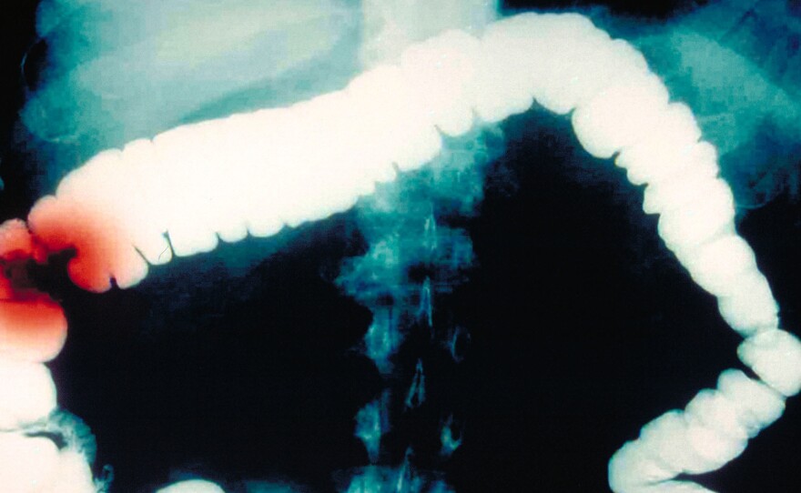 This computer-enhanced barium contrast X-ray shows colon cancer in red. Researchers have been trying to figure out what looks to be a decade-long rise in colon cancer among people younger than 50.