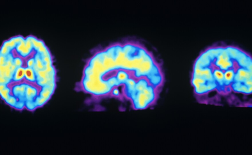 These PET scans show the normal distribution of opioid receptors in the human brain. A new study suggests ketamine may activate these receptors, raising concern it could be addictive.