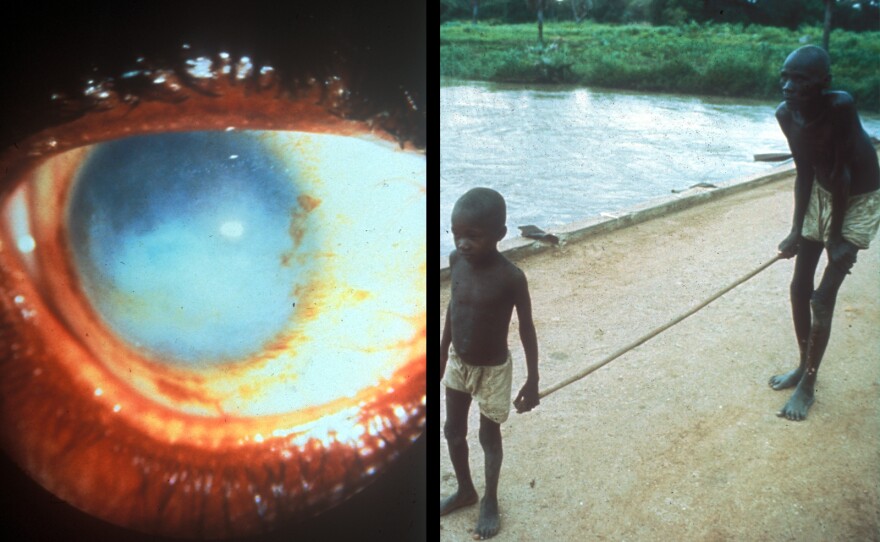 River blindness affects more than 37 million people.