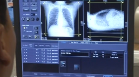 Low dose CT scan