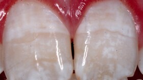 Mild forms of dental fluorosis (shown in teeth pictured above) are increasingly common, according to the American Dental Association, and cause teeth to become discolored, most often with white streaks. 