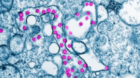 Viral particles are colorized purple in this color-enhanced transmission electron micrograph from a COVID-19 patient in the United States. Computer modeling can help epidemiologists predict how and where the illness will move next.