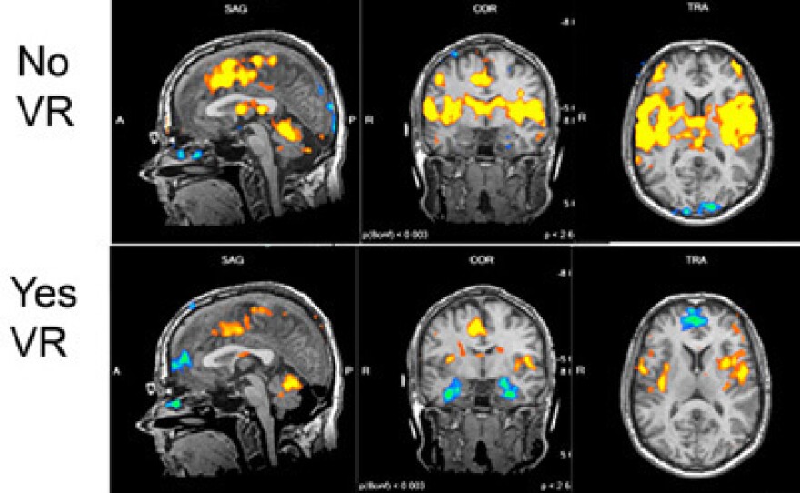 These images from an fMRI scan show areas of the brain affected by pain, and how those activated areas quieted down for one test patient who donned a headset that immersed the patient in a virtual reality world.