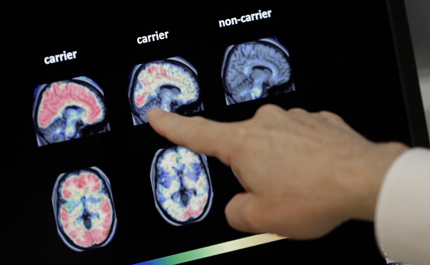 Dr. William Burke goes over a PET brain scan in 2018 at Banner Alzheimers Institute in Phoenix. The drug company Biogen Inc. has received federal approval for a medicine to treat early Alzheimer's disease.