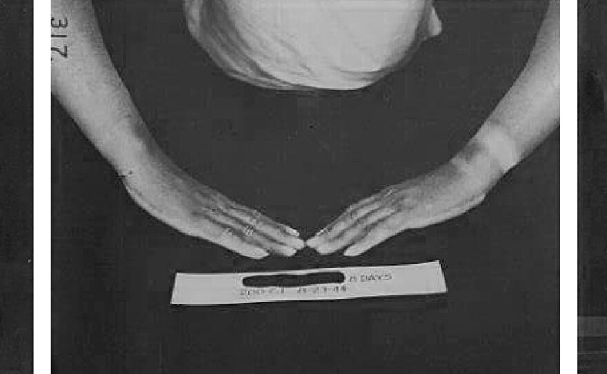 Historic images from the Naval Research Laboratory depict results of a test subject who was exposed to mustard gas.