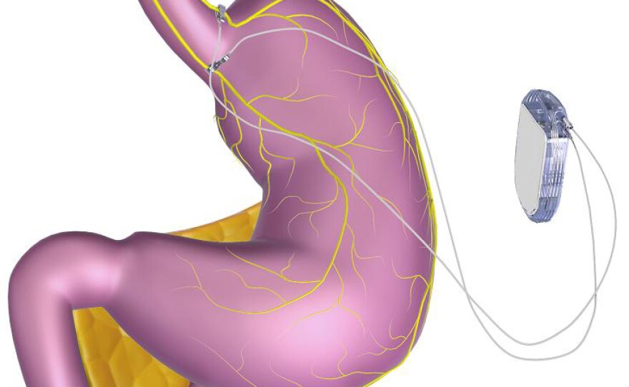 The device is intended to interrupt signals sent from the stomach to the brain.