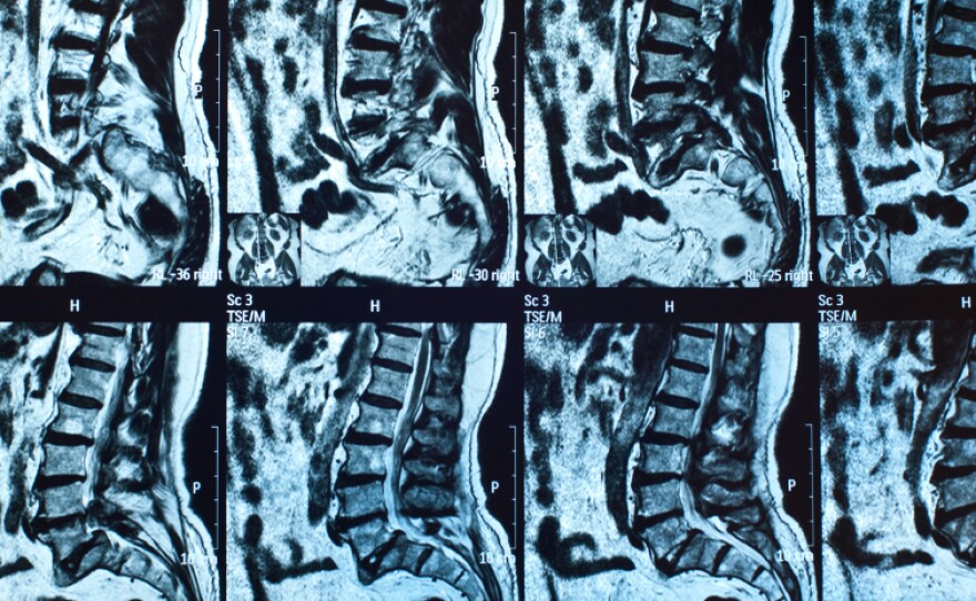 Spinal MRIs similar to these found infections that many patients hadn't realized they had.