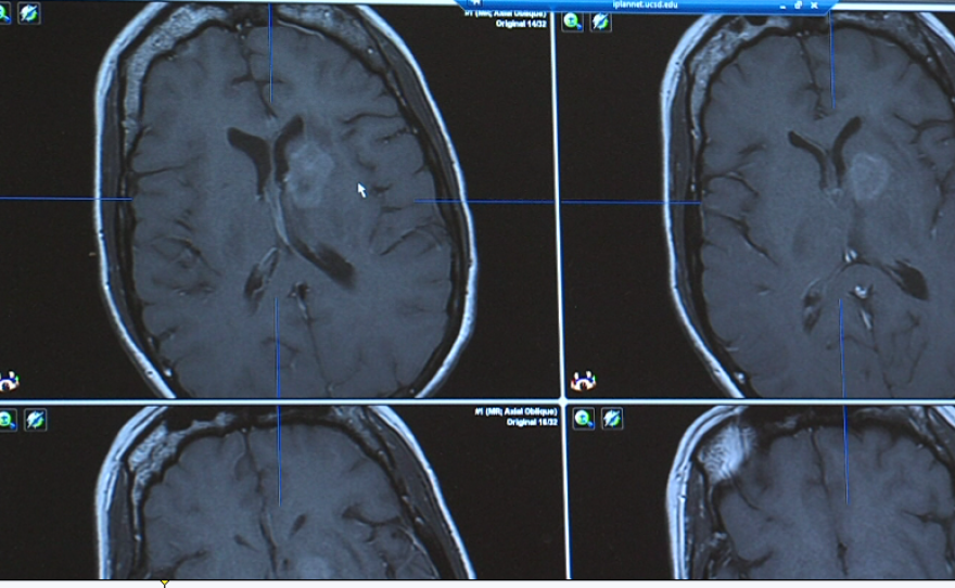 A standard MRI of Carpinelli's brain shows just the barest outlines of her tumor.