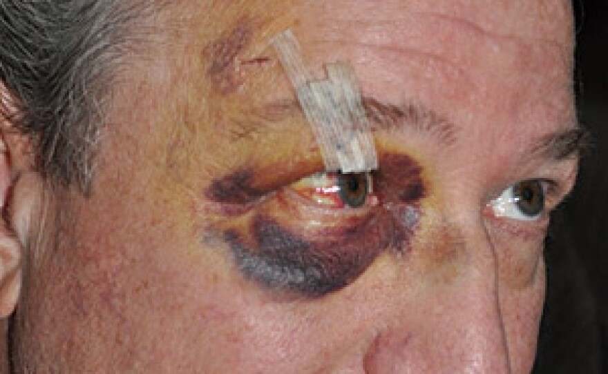 Dr. Richard Frishman, a psychiatrist at Napa State Hospital, photographed after he was attacked by a patient.