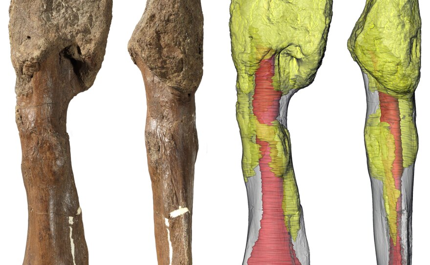 Two views of the <em>Centrosaurus apertus</em> shin bone (fibula) with malignant bone cancer (osteosarcoma). The extensive invasion of the cancer throughout the bone (yellow) suggests that it persisted for a considerable period of the dinosaur's life and may have spread to other parts of the body prior to death.