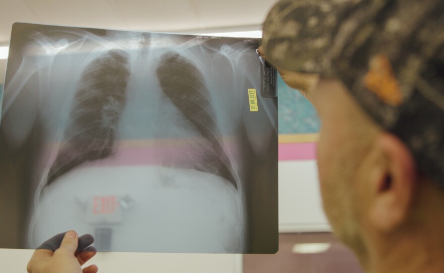 Coal miner Nick Stiltner reviews an X-ray of his lungs showing black lung disease at the Stone Mountain Clinic in Grundy, Va.
