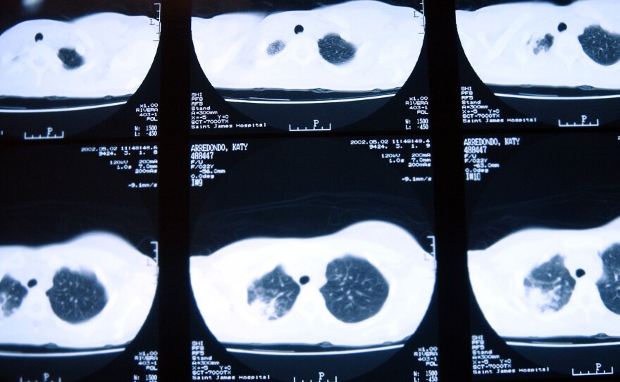 CT scans of a patient with tuberculosis, taken in November 2002 in New Jersey, show damage to the lungs.