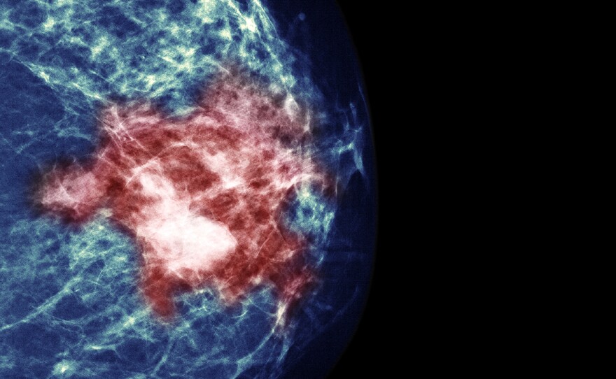 By testing tumors, researchers hoped to identify women who could avoid chemotherapy without increasing their risk of a cancer recurrence.