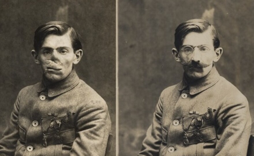 Ladd's papers include these photos of a World War I veteran with and without his mask, circa 1920.