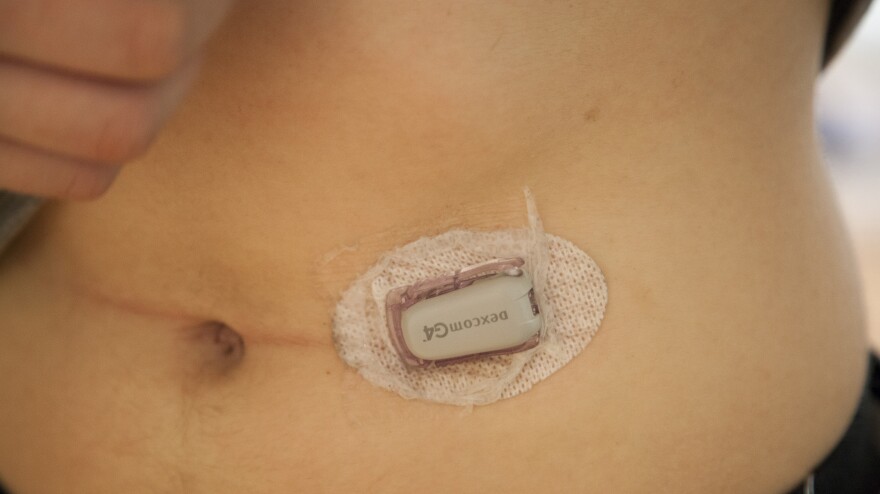 David wears a transmitter on his abdomen that sends data on his glucose levels to a monitoring unit.