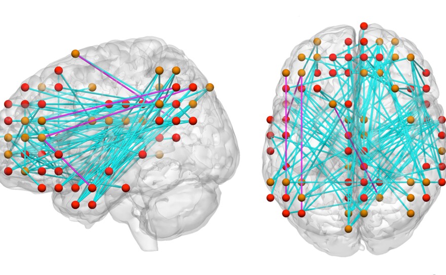 Maps of connections in the brain are helping researchers better understand attention deficit hyperactivity disorder.