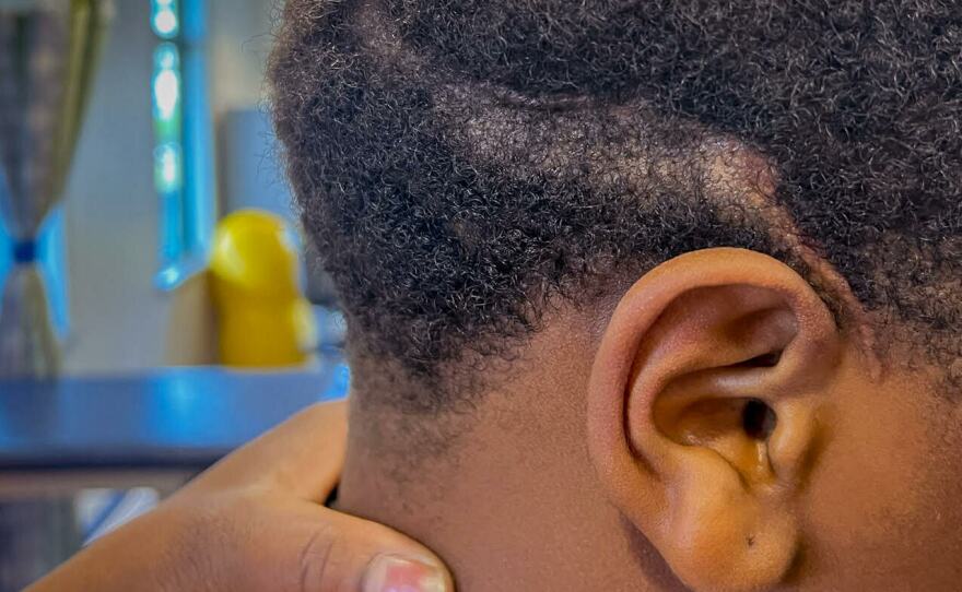 A twisting scar left behind after a bullet entered Aaron Hunter's brain on June 22, 2023. After emergency surgery at Johns Hopkins All Children's Hospital in St. Petersburg, Florida, the surgeon warned that the 13-year-old's ability to walk, see and speak could be affected. He spent weeks in the hospital followed by eight months of physical and occupational therapy.