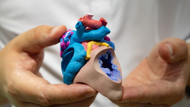 Justin Ryan holds a patients heart model. The heart has a hole in it, a common birth defect. These models are used in surgical planning. 