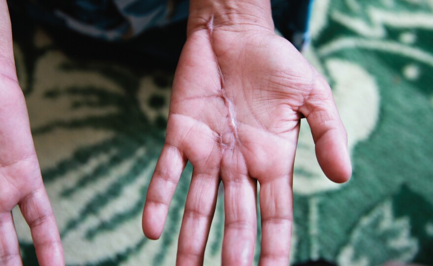 A knife attack by this woman's husband left the scar on her palm. He had accused her of interacting with men who weren't from her immediate family at their wedding. She is incarcerated at Herat Women's Prison for moral crimes.