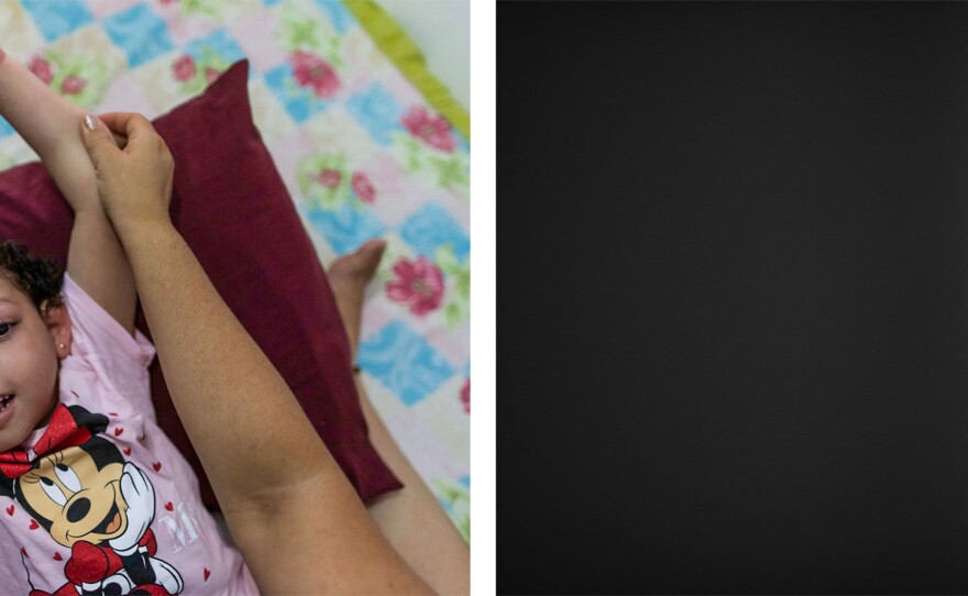 Left: Dos Santos helps her daughter, pictured, with physical therapy. Many children with congenital Zika disorder are physically disabled. Right: Due to difficulties swallowing, dos Santos' daughter uses a feeding tube, which is attached to her wheelchair.