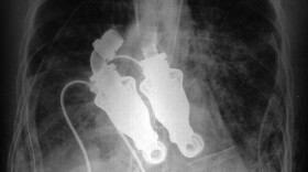 An X-ray shows the dual turbinelike blood pumps that replaced Craig Lewis' heart. These devices were used in a last attempt to save his life.