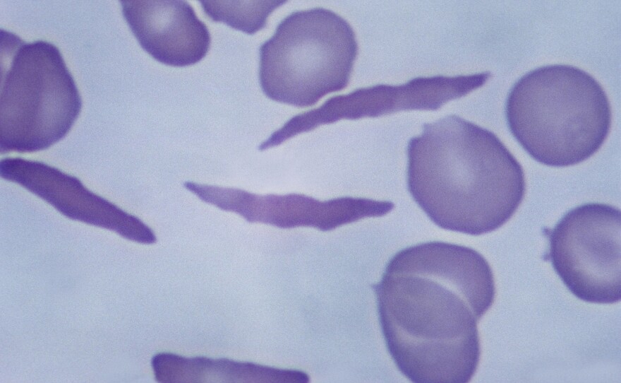 Patients with sickle cell disease have blood cells that are stiff and misshapen. The cells don't carry oxygen as well and clog up the bloodstream, resulting in periodic bouts of excruciating pain.
