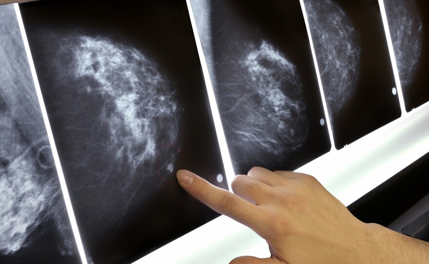 In a study of 1.3 million women, ages 40 to 74, having a false positive on a screening mammogram was associated with a slightly increased chance that the woman would eventually develop breast cancer. The extra risk seemed to be independent of the density of her breasts.
